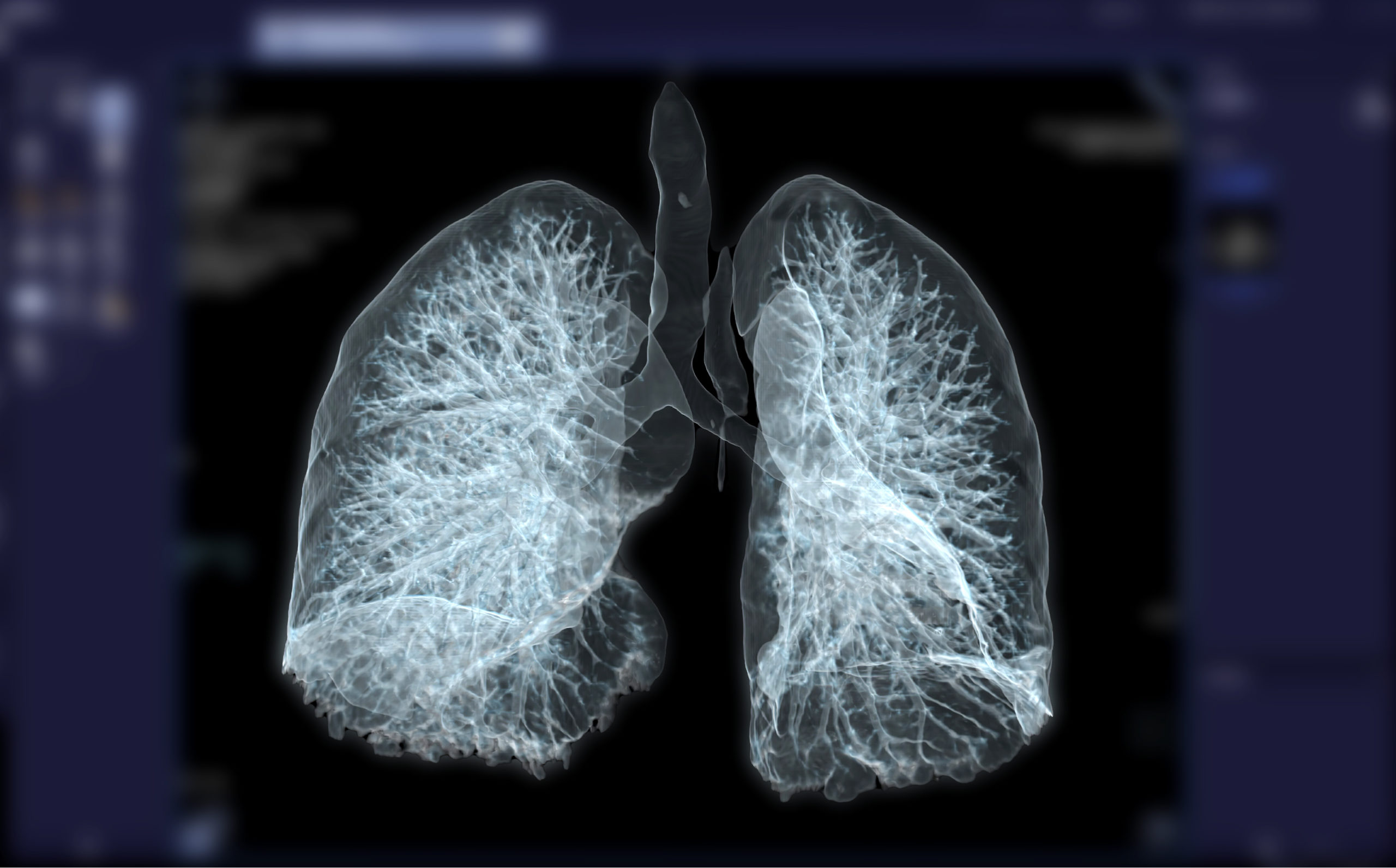 what is a lung nodule